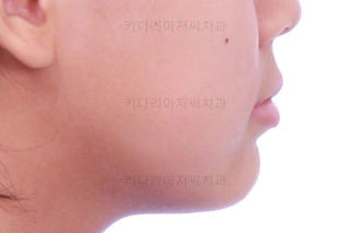 부산부분교정