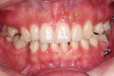 부산인비절라인