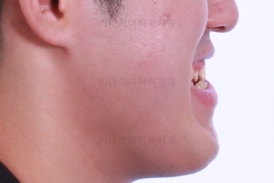 부산긴얼굴긴턱교정