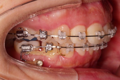 부산무턱교정치과