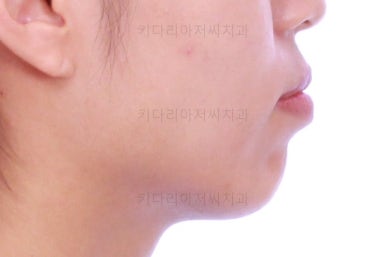 부산연산역치아교정