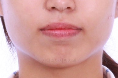 부산연산역치아교정