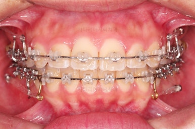 부산연산역치아교정