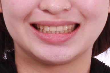 부산돌출입교정