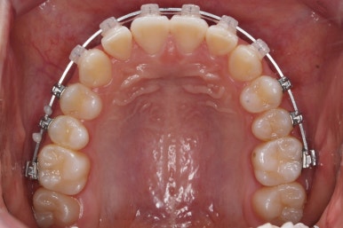 부산치아교정잘하는곳