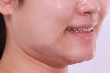 부산치아교정잘하는곳