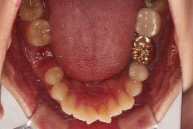 부산사랑니교정