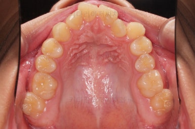 부산비발치교정