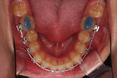 부산비발치교정