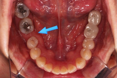 연산동부분교정