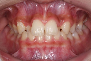 부산비발치교정