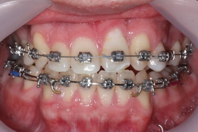 부산구순구개열