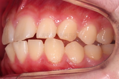 부산연산동사랑니발치