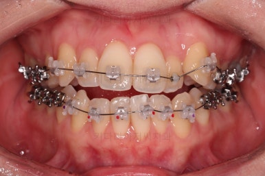 부산치아교정잘하는곳