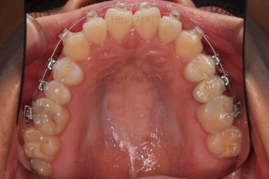 부산치아교정잘하는곳