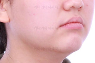 부산덧니교정