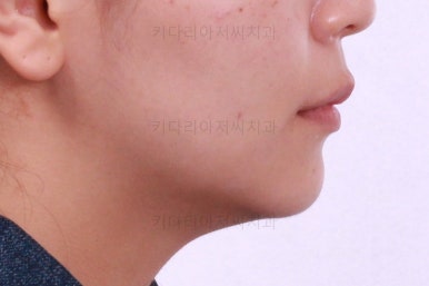 부산사랑니교정