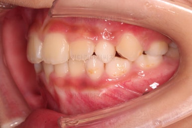 부산어린이교정