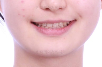 동래구치아교정