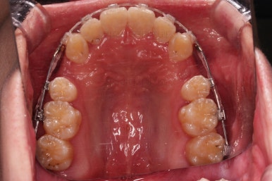 부산돌출입교정