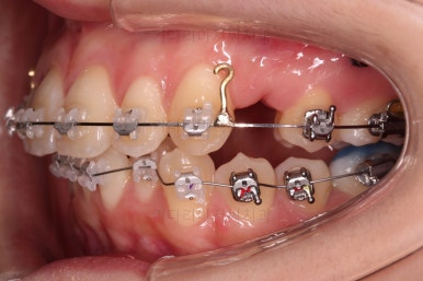 부산돌출입교정
