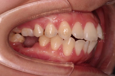 부산사랑니교정