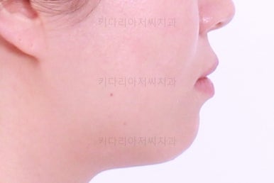 부산치아교정잘하는곳