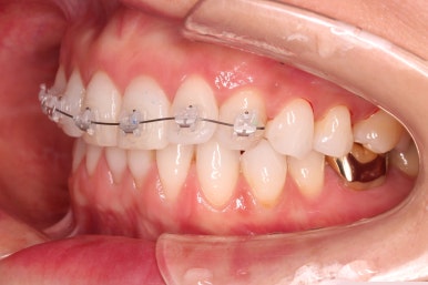 연산동부분교정