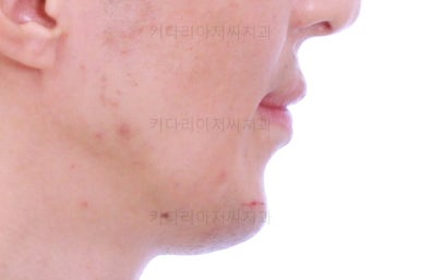 부산구순구개열교정