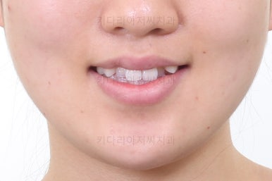 부산비발치교정