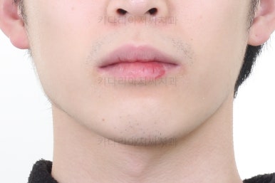 부산돌출입교정