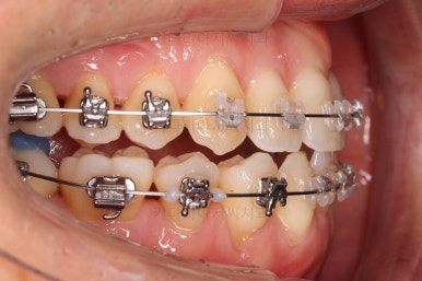 부산비수술교정