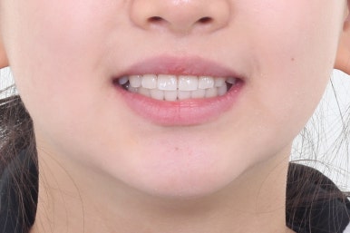 부산치아교정잘하는곳