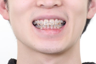 부산돌출입교정