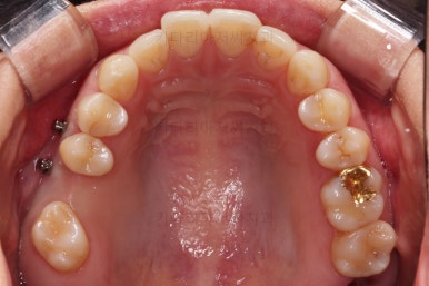 부산치아교정비용