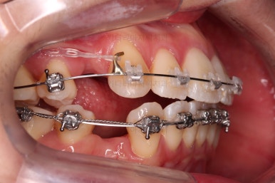 부산치아교정잘하는치과