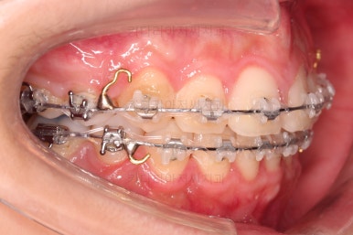 부산클리피씨교정