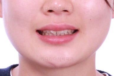 부산앞니부분교정