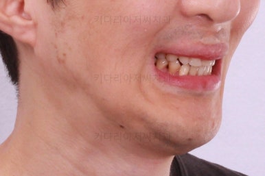 부산구순구개열교정