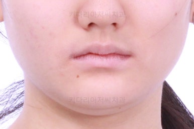 연산동치아교정