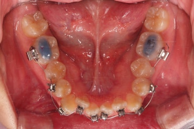 동래구치아교정