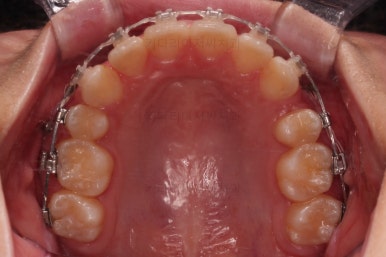 연산동치아교정