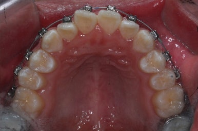 부산주걱턱교정