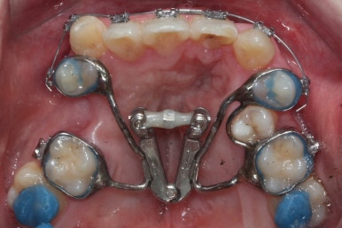부산구순구개열