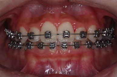부산비발치교정