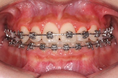 부산비발치교정