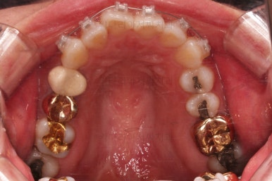 부산부분치아교정