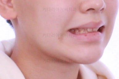 부산연산동치아교정