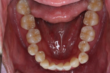 부산비수술교정