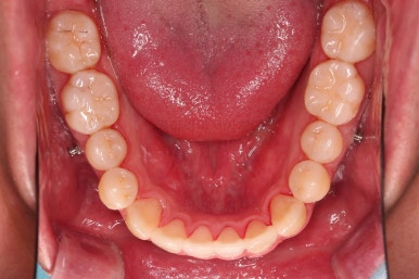 부산인비절라인